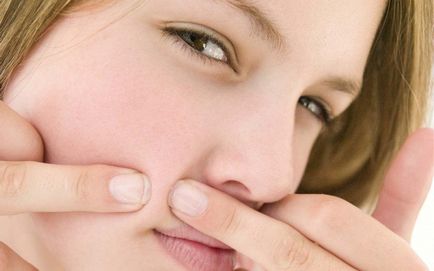 Cum de a stoarce clasificarea acnee cosuri si cum sa le rezolve