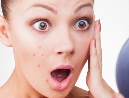 Cum de a stoarce clasificarea acnee cosuri si cum sa le rezolve