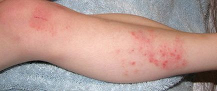 Piele dermatită de tratament fotografie la copii, adulți, unguente, provoacă simptome