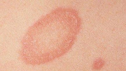 piele roz herpesul boli la copii cauze, tratament