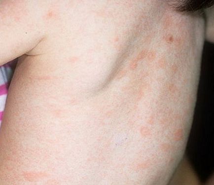 piele roz herpesul boli la copii cauze, tratament