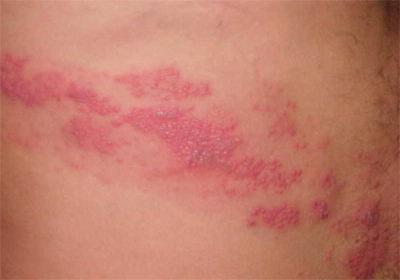 Tratamentul de herpes zoster în căile de atac acasă populare