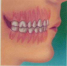 Malocluzie de dinți