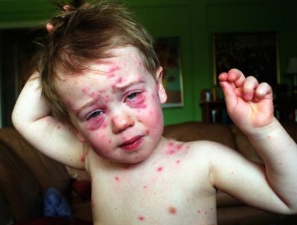 Complicațiile de la varicela la copii efectele de varicela, care poate fi complicații la copii sub