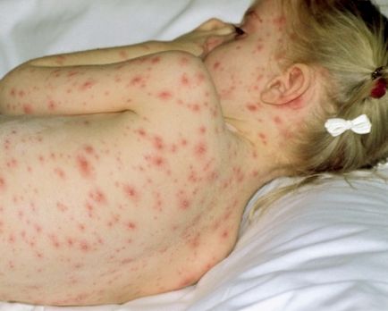 Complicațiile de la varicela la copii efectele de varicela, care poate fi complicații la copii sub