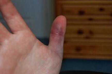 Un deget fracturat pe braț și picior simptomele sale, modul de a determina un tratament