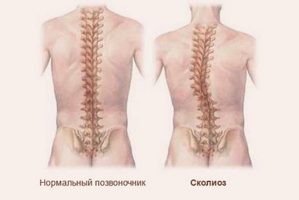 Indicații pentru IRM a coloanei vertebrale, contraindicații