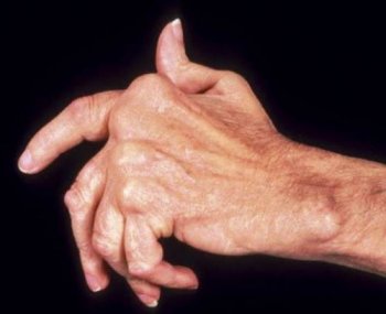 Artrita - simptome și tratament, cauzele