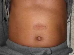 hernie abdomen Postoperator - simptome, tratament, fotografii