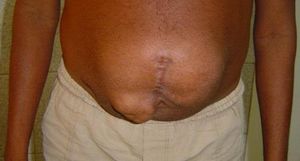 hernie abdomen Postoperator - simptome, tratament, fotografii