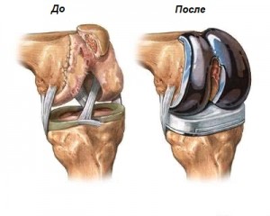 inlocuire a genunchiului