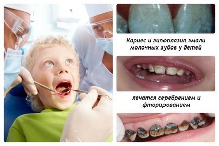 Argintare comentarii dinții de lapte, Komorowski, înainte și după fotografii, alternative