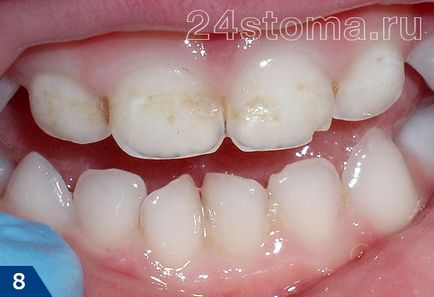 Argintare a dinților la copii - comentarii, fotografii, pro și contra