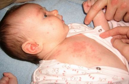 Febră și erupții cutanate la un copil