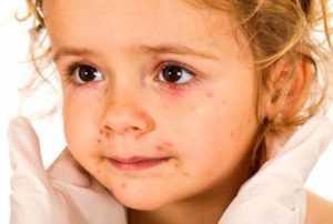 Febră și erupții cutanate la un copil