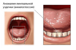limba frenul