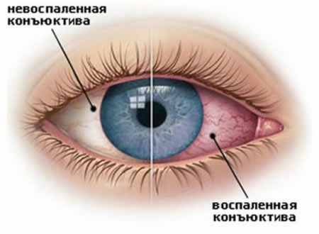 Inflamarea tratamentului pentru ochi și prevenirea