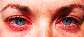 Alergia mancarimi ale ochilor si apoase, umflate - edem decât pentru tratarea pleoapelor de copii și adulți
