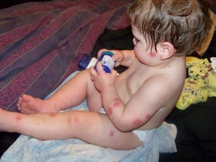 Alergic la intepaturi de tantar un copil, alergie la copii