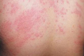simptome alergice ale pielii, tratament, fotografii