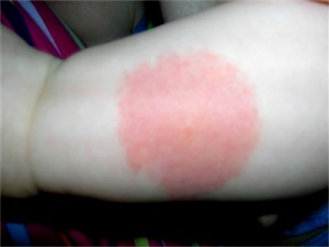 Alergic la mușcăturile de țânțari și alte insecte la copii fotografie, tratamentul copilului