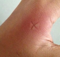 Alergic la mușcăturile de țânțari și musculițe - vara de apel și mâncărime