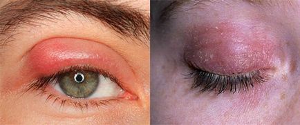 Alergia din cauze pleoapelor ochi, simptome, tratament