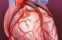 chirurgie sau președinți de by-pass aorto-coronarian - infarct