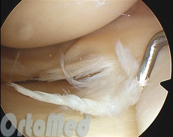 rezecția artroscopica a meniscului genunchiului, reabilitare după o intervenție chirurgicală, artroscopie