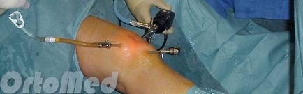 rezecția artroscopica a meniscului genunchiului, reabilitare după o intervenție chirurgicală, artroscopie