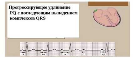 Bloc cardiac ce este, simptome și tratament