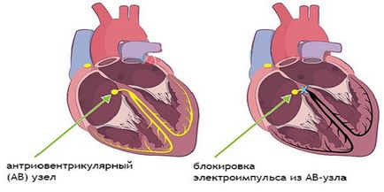 Bloc cardiac ce este, simptome și tratament