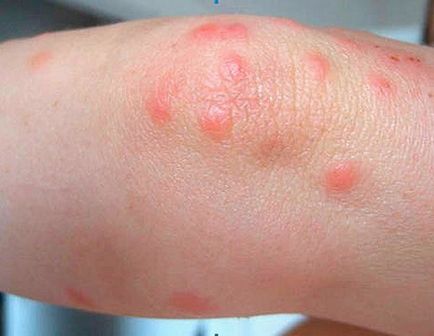 Mușcăturilor de țânțar frotiu, unguente, creme, geluri, și remedii populare
