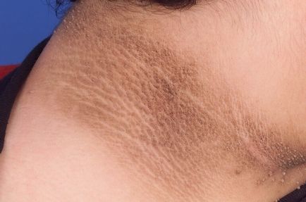 Acanthosis nigricans la om cauze, tratament, fotografii