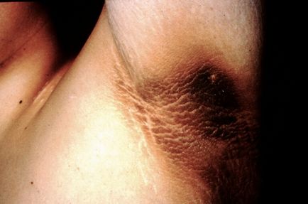 Acanthosis nigricans la om cauze, tratament, fotografii