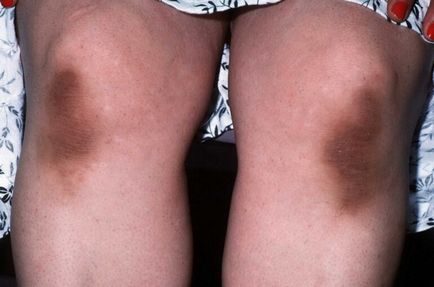 Acanthosis nigricans la om cauze, tratament, fotografii