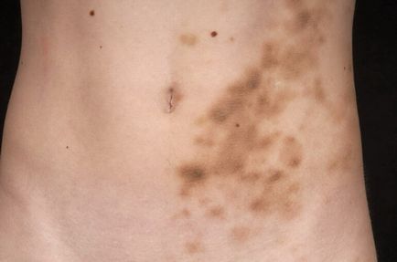 Acanthosis nigricans la om cauze, tratament, fotografii