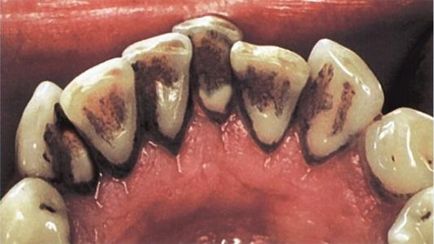 patina negru pe dinti pentru copii si adulti cauze, cum să eliminați
