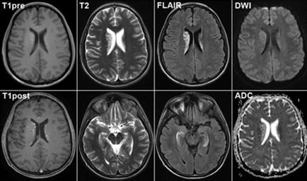 Ce CT mai bine sau rezonanță magnetică a creierului și modul în care acestea diferă