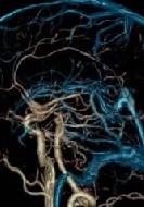 Ce CT sau RMN mai bine diferentele de imagistica creierului