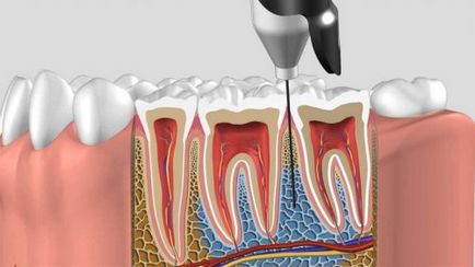 Ce se poate face pentru a îngheța dintele a trecut repede, eliminarea anesteziei