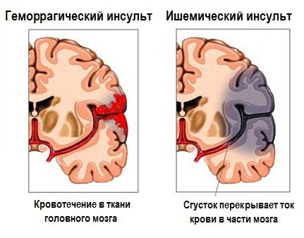 Care sunt primele semne ale unui atac cerebral și consecințele posibile