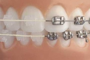 Ce este ortodonție în stomatologie și ce ortodont medicul