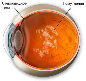 Distrugerea ochiului vitros cauze, simptome și tratament