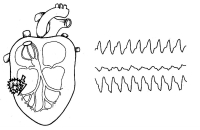 Clare și detaliate cu privire la formele atipice de infarct miocardic
