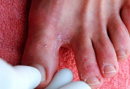 tratamente eficiente pentru ciuperca între degetele de la picioare dvs. de medicamente, chirurgie si
