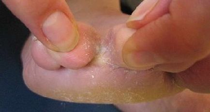 tratamente eficiente pentru ciuperca între degetele de la picioare dvs. de medicamente, chirurgie si