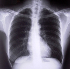 Diagnosticul de boli pulmonare