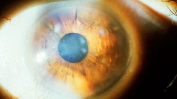 tratamentul corneei ochi distrofie și că este, epitelială, endoterialnaya, remedii populare