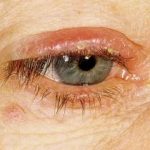 tratamentul corneei ochi distrofie și că este, epitelială, endoterialnaya, remedii populare